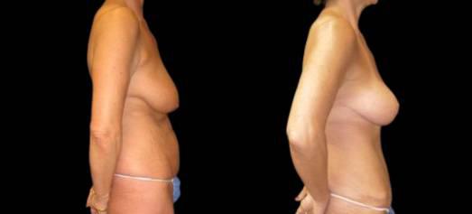 Breast Lift result at Bitar Cosmetic Surgery Institute & Medspa in Fairfax, VA