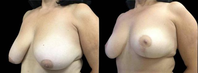 Breast Lift result at Bitar Cosmetic Surgery Institute & Medspa in Fairfax, VA