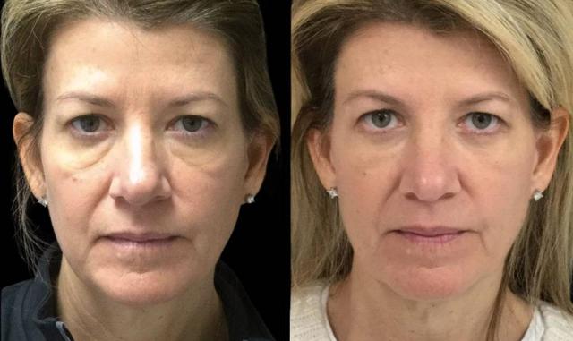 Blepharoplasty result at Bitar Cosmetic Surgery Institute & Medspa in Fairfax, VA