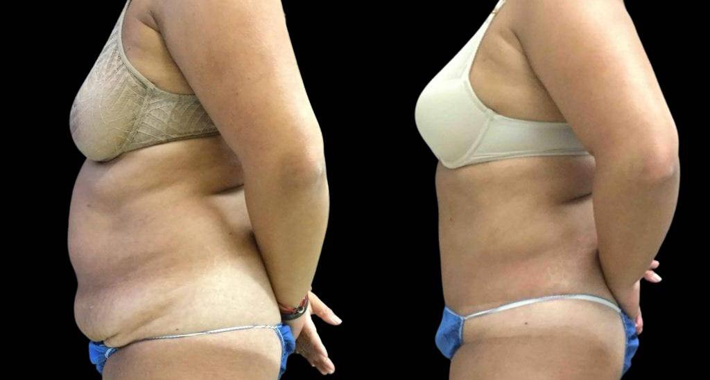 Bitar Cosmetic Surgery Institute & Medspa tummy tuck result — Fairfax, VA