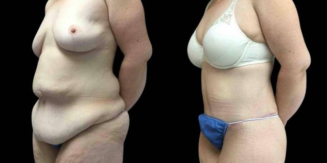 CoolSculpting result at Bitar Cosmetic Surgery Institute & Medspa in Fairfax, VA