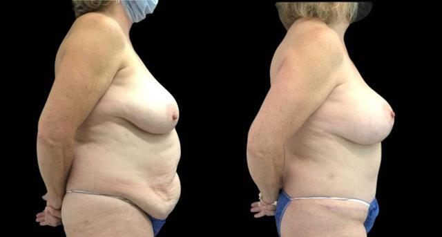 Mommy Makeover result at Bitar Cosmetic Surgery Institute & Medspa in Fairfax, VA