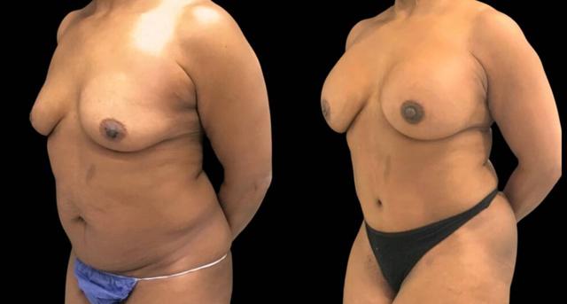 Fat Transfer Breast Augmentation result at Bitar Cosmetic Surgery Institute & Medspa in Fairfax, VA