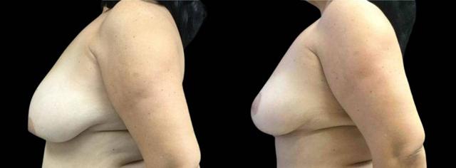 Breast Lift result at Bitar Cosmetic Surgery Institute & Medspa in Fairfax, VA