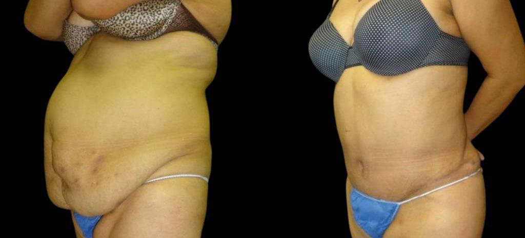 Bitar Cosmetic Surgery Institute & Medspa result — Fairfax, VA