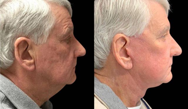 Fat Transfer result at Bitar Cosmetic Surgery Institute & Medspa in Fairfax, VA