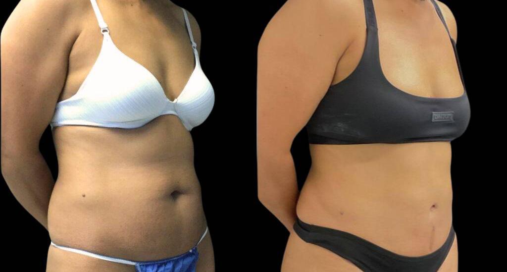 Bitar Cosmetic Surgery Institute & Medspa tummy tuck result — Fairfax, VA