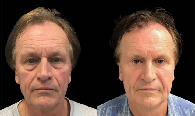 Blepharoplasty result at Bitar Cosmetic Surgery Institute & Medspa in Fairfax, VA