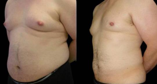 Gynecomastia Surgery result at Bitar Cosmetic Surgery Institute & Medspa in Fairfax, VA