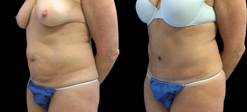 Bitar Cosmetic Surgery Institute & Medspa result — Fairfax, VA