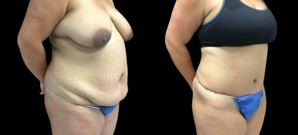 Bitar Cosmetic Surgery Institute & Medspa result — Fairfax, VA