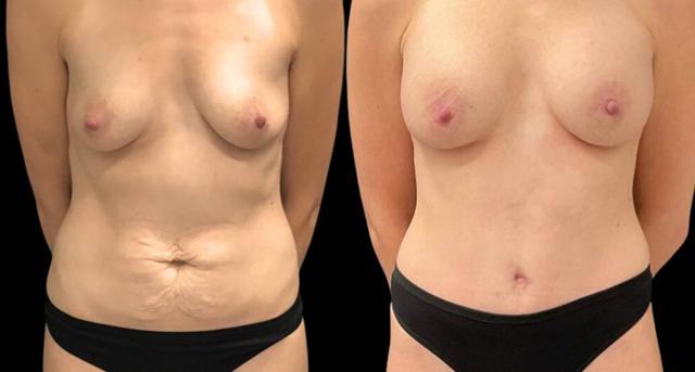 Mommy Makeover result at Bitar Cosmetic Surgery Institute & Medspa in Fairfax, VA