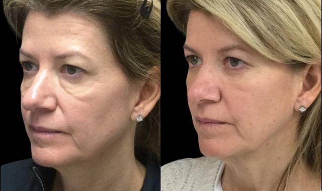 Blepharoplasty result at Bitar Cosmetic Surgery Institute & Medspa in Fairfax, VA