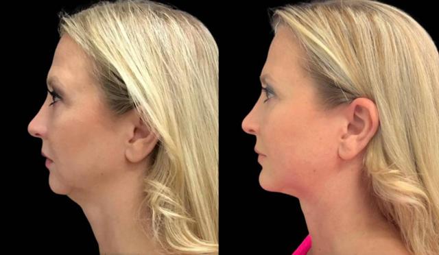 Fat Transfer result at Bitar Cosmetic Surgery Institute & Medspa in Fairfax, VA