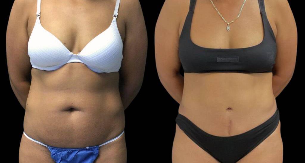Bitar Cosmetic Surgery Institute & Medspa tummy tuck result — Fairfax, VA