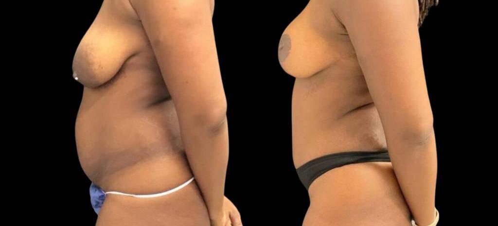 Bitar Cosmetic Surgery Institute & Medspa result — Fairfax, VA