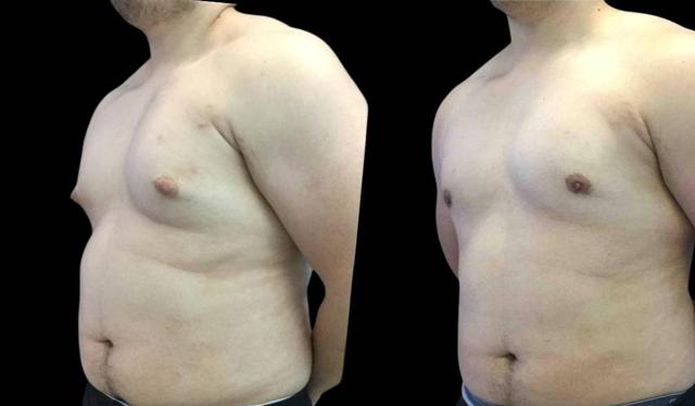Breast Reduction result at Bitar Cosmetic Surgery Institute & Medspa in Fairfax, VA
