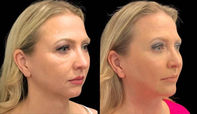 Fat Transfer result at Bitar Cosmetic Surgery Institute & Medspa in Fairfax, VA