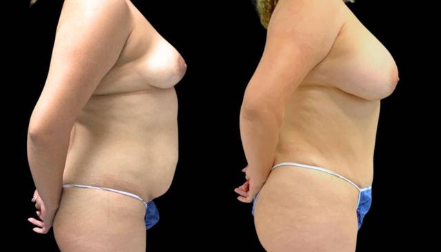 Mommy Makeover result at Bitar Cosmetic Surgery Institute & Medspa in Fairfax, VA