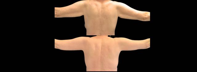 Breast Lift result at Bitar Cosmetic Surgery Institute & Medspa in Fairfax, VA
