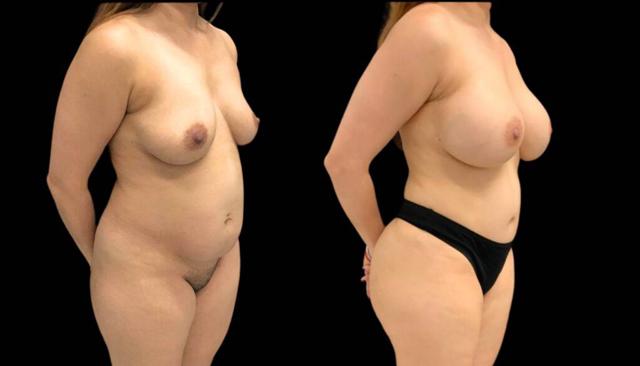 Mommy Makeover result at Bitar Cosmetic Surgery Institute & Medspa in Fairfax, VA