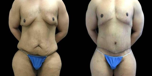 CoolSculpting result at Bitar Cosmetic Surgery Institute & Medspa in Fairfax, VA