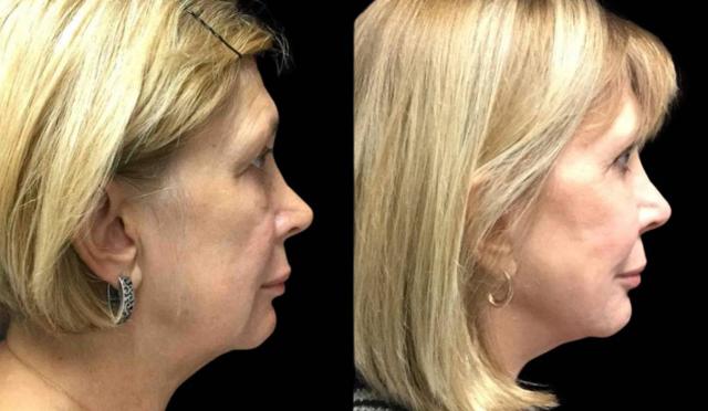 Facelift result at Bitar Cosmetic Surgery Institute & Medspa in Fairfax, VA