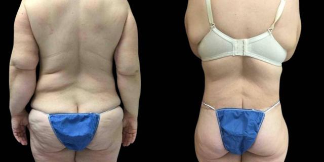 CoolSculpting result at Bitar Cosmetic Surgery Institute & Medspa in Fairfax, VA