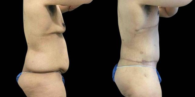 CoolSculpting result at Bitar Cosmetic Surgery Institute & Medspa in Fairfax, VA