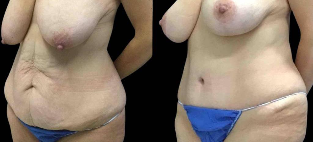 Bitar Cosmetic Surgery Institute & Medspa result — Fairfax, VA