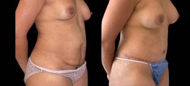 Breast Lift result at Bitar Cosmetic Surgery Institute & Medspa in Fairfax, VA