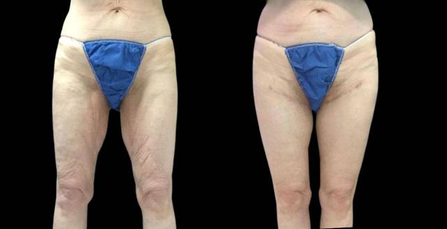 Thigh Lift result at Bitar Cosmetic Surgery Institute & Medspa in Fairfax, VA