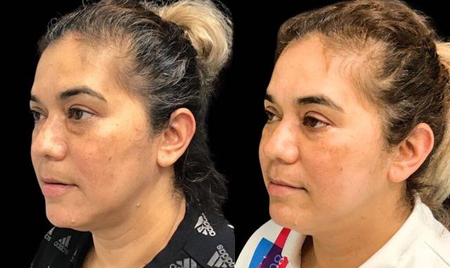 Blepharoplasty result at Bitar Cosmetic Surgery Institute & Medspa in Fairfax, VA