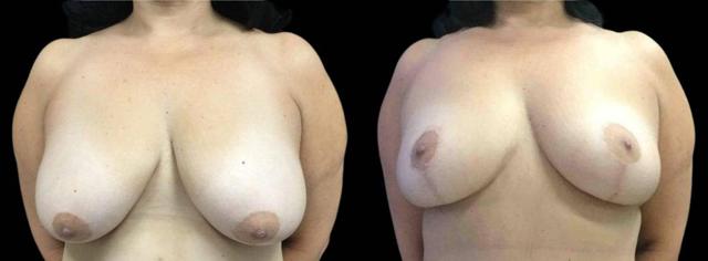 Breast Lift result at Bitar Cosmetic Surgery Institute & Medspa in Fairfax, VA