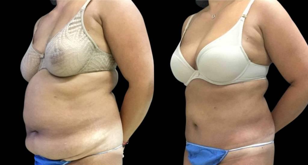 Bitar Cosmetic Surgery Institute & Medspa tummy tuck result — Fairfax, VA