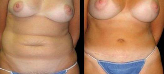 Bitar Cosmetic Surgery Institute & Medspa result — Fairfax, VA