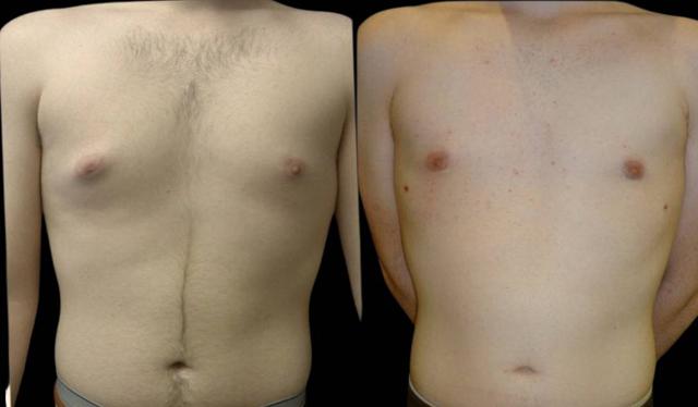 Breast Reduction result at Bitar Cosmetic Surgery Institute & Medspa in Fairfax, VA