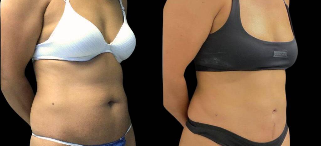 Bitar Cosmetic Surgery Institute & Medspa result — Fairfax, VA