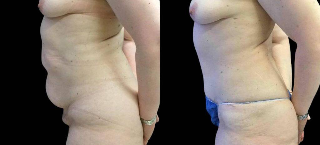 Bitar Cosmetic Surgery Institute & Medspa result — Fairfax, VA