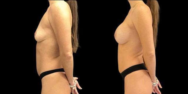 Breast Augmentation result at Bitar Cosmetic Surgery Institute & Medspa in Fairfax, VA