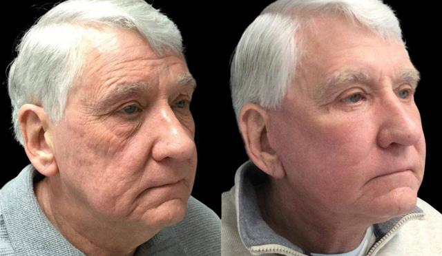 Fat Transfer result at Bitar Cosmetic Surgery Institute & Medspa in Fairfax, VA