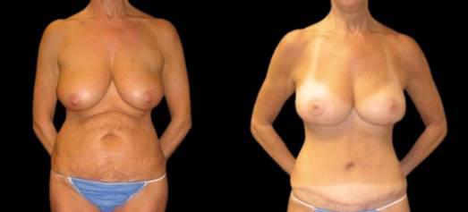 Breast Lift result at Bitar Cosmetic Surgery Institute & Medspa in Fairfax, VA