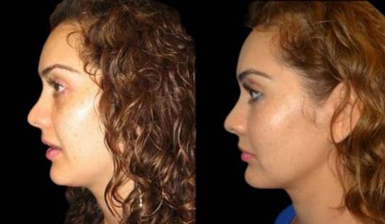 Ethnic Rhinoplasty result at Bitar Cosmetic Surgery Institute & Medspa in Fairfax, VA