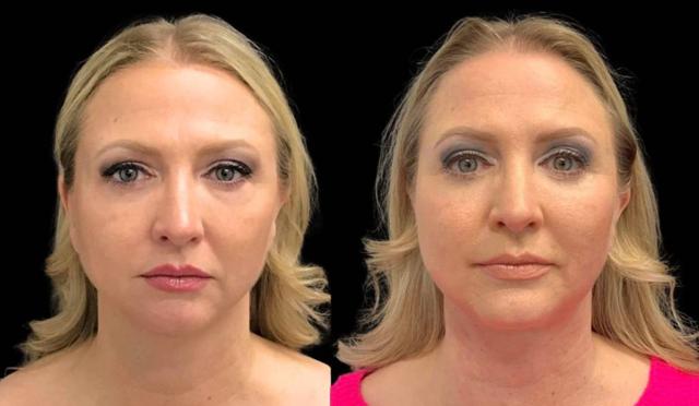 Fat Transfer result at Bitar Cosmetic Surgery Institute & Medspa in Fairfax, VA