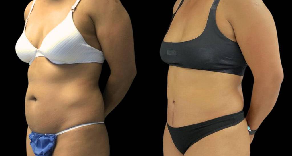 Bitar Cosmetic Surgery Institute & Medspa tummy tuck result — Fairfax, VA