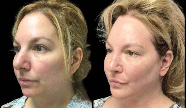 Brazilian Butt Lift result at Bitar Cosmetic Surgery Institute & Medspa in Fairfax, VA