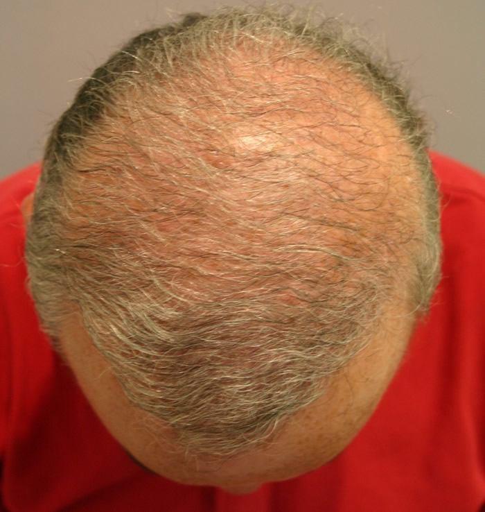 Golden Triangle Facial Plastic Surgery after — San Diego, CA