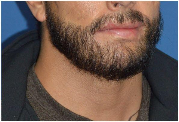 Golden Triangle Facial Plastic Surgery after — San Diego, CA