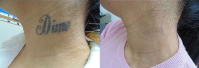Laser Skin Resurfacing result at Golden Triangle Facial Plastic Surgery in San Diego, CA