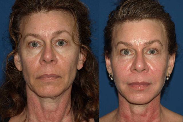 Fat Transfer result at Golden Triangle Facial Plastic Surgery in San Diego, CA